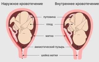 Предупреждение кровотечения из носа на втором и третьем триместре беременности