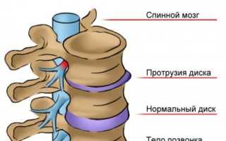 Протрузии позвоночника: причины и лечение