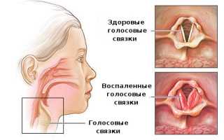 Чем рекомендуется лечить потерю голоса из-за ларингита у взрослых