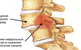 Как вправить позвоночник в домашних условиях правильно и безопасно