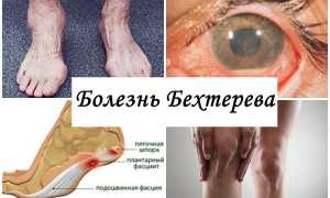 Болезнь Бехтерева – диагностика и лечение: важные аспекты