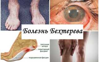 Болезнь Бехтерева – диагностика и лечение: важные аспекты