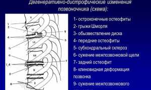 Субхондральный склероз позвоночника: причины и лечение
