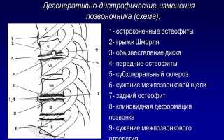 Субхондральный склероз позвоночника: причины и лечение