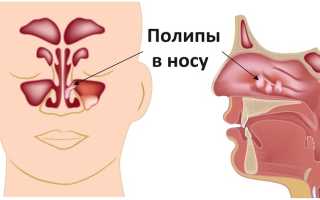 Лечение наростов в носу: эффективные методы и рекомендации