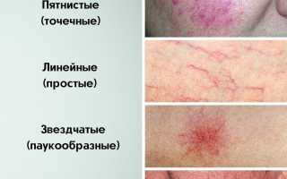 Причины появления капилляров на носу и эффективные способы лечения купероза у женщин