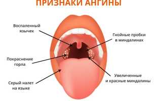 Каковы особенности лечения ангины Симановского-Венсана у взрослых