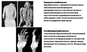 Оссифицирующий миозит: причины и лечение
