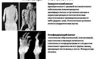 Оссифицирующий миозит: причины и лечение