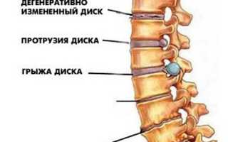 Питание при грыже поясничного отдела позвоночника: советы и рекомендации