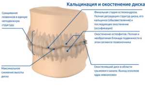 Соли в спине: причины и последствия
