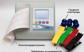 Кардиограмма сердца расшифровка норма