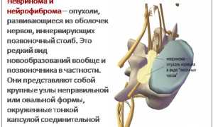 Невринома позвоночника: причины, симптомы и лечение