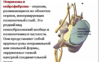 Невринома позвоночника: причины, симптомы и лечение
