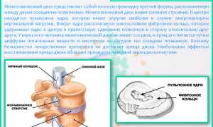 Антеспондилолистез позвоночника – что это такое и как с этим жить?