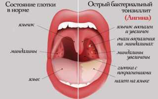 Длительность ангины и последствий для здоровья