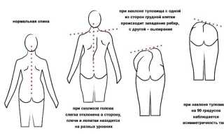 Лечение сколиоза 2 степени: методы и рекомендации