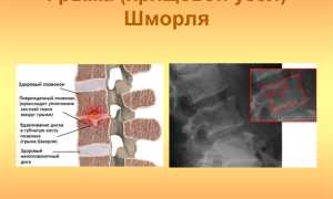 Узлы Шморля в позвоночнике: причины и лечение