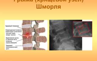 Узлы Шморля в позвоночнике: причины и лечение