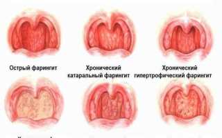 Секреты лечения хронического фарингита: полезные советы и рекомендации