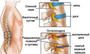 Боли при остеохондрозе: причины и лечение
