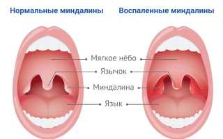 Опасность дырок в гландах и лечение этой патологии для здоровья