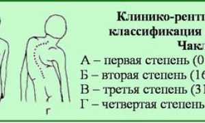 Как определить сколиоз на ранней стадии у детей