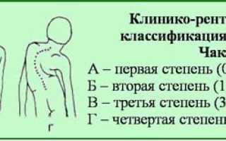 Как определить сколиоз на ранней стадии у детей