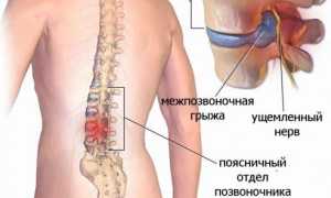 Упражнения для позвоночника при грыже в пояснице для улучшения здоровья