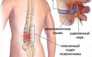 Упражнения для позвоночника при грыже в пояснице для улучшения здоровья