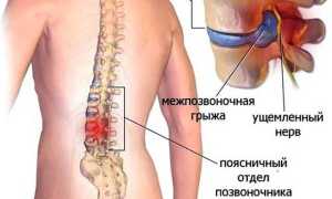 Зарядка при грыже позвоночника поясничного отдела для улучшения здоровья