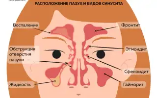 Причины возникновения и признаки катарального гайморита: важные аспекты для понимания