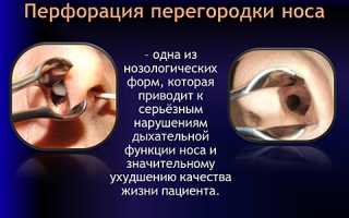 Методы устранения перфорации носовой перегородки: советы и рекомендации