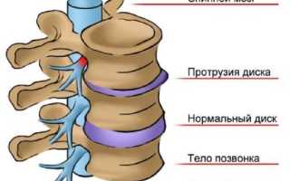 Протрузия грудного отдела позвоночника: причины и лечение