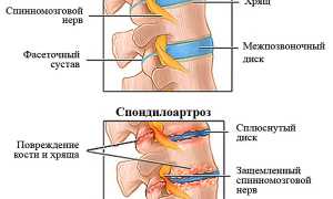 Спондилоартроз 2 степени поясничного отдела позвоночника: лечение и профилактика