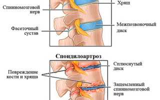 Спондилоартроз 2 степени поясничного отдела позвоночника: лечение и профилактика