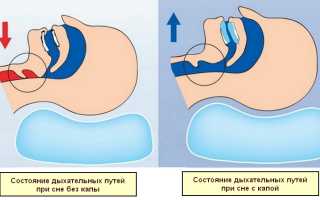 Как использовать капу от храпа для улучшения сна