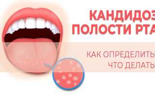 Диагностика и лечение кандидоза горла: важные аспекты здоровья