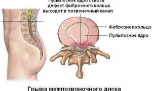 Грыжа позвоночника: лечение без операции народными средствами и рекомендациями