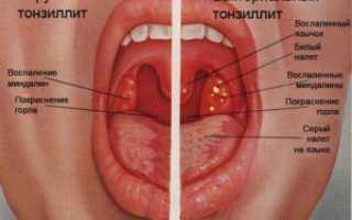 Признаки и методы лечения тонзиллита у взрослых и детей
