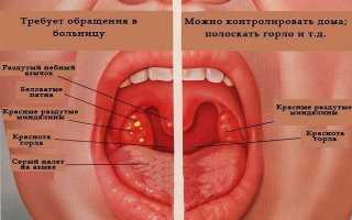 Лечение ангины с помощью народных средств в домашних условиях