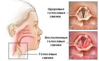 Распространенные заболевания, характеризующиеся болью в гортани, и их симптомы