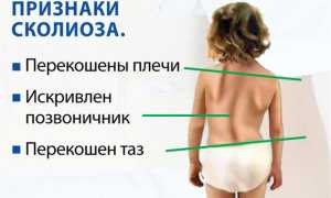 Одно плечо выше другого: как исправить проблему с осанкой?