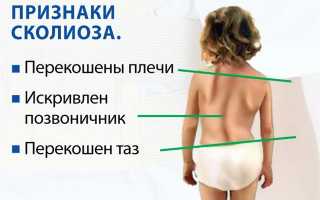 Одно плечо выше другого: как исправить проблему с осанкой?