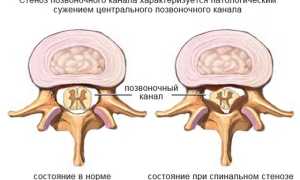 Стеноз позвоночного канала в поясничном отделе: причины и лечение