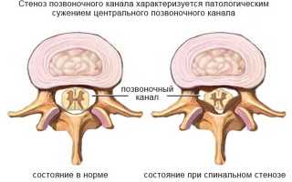 Стеноз позвоночного канала в поясничном отделе: причины и лечение