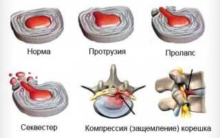 Корсет при грыже поясничного отдела позвоночника: важные аспекты применения