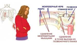 Массаж при межреберной невралгии: полезные советы и рекомендации