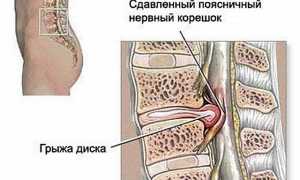 Упражнения при грыже пояснично-крестцового отдела позвоночника для улучшения состояния
