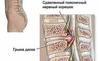 Упражнения при грыже пояснично-крестцового отдела позвоночника для улучшения состояния